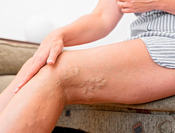 Como evitar trambose?