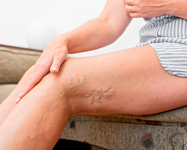 Como evitar trambose?