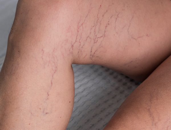 Varizes não são só estética. São um sinal de alerta!