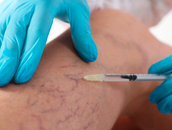 Você sabia que é possível tratar varizes sem cirurgia?