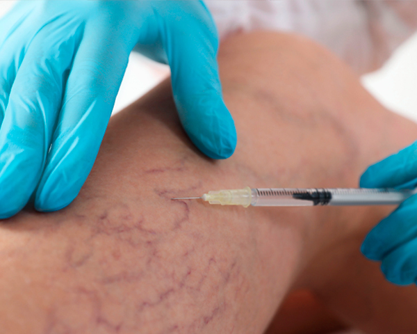 Você sabia que é possível tratar varizes sem cirurgia?